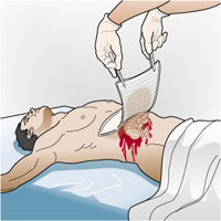 Abdominal Wounds